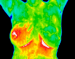 Inflammatory carcinoma