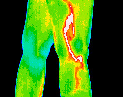 Carotid artery inflammation