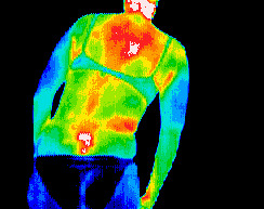 Carotid artery inflammation